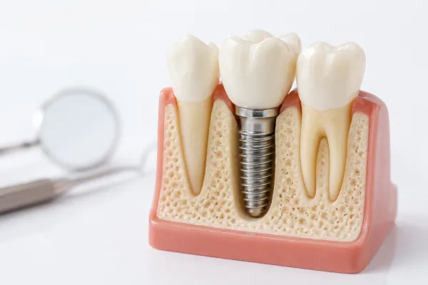 Dental Implants